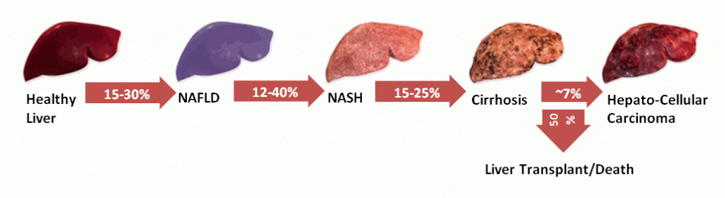 Noninvasive Biomarkers in NASH